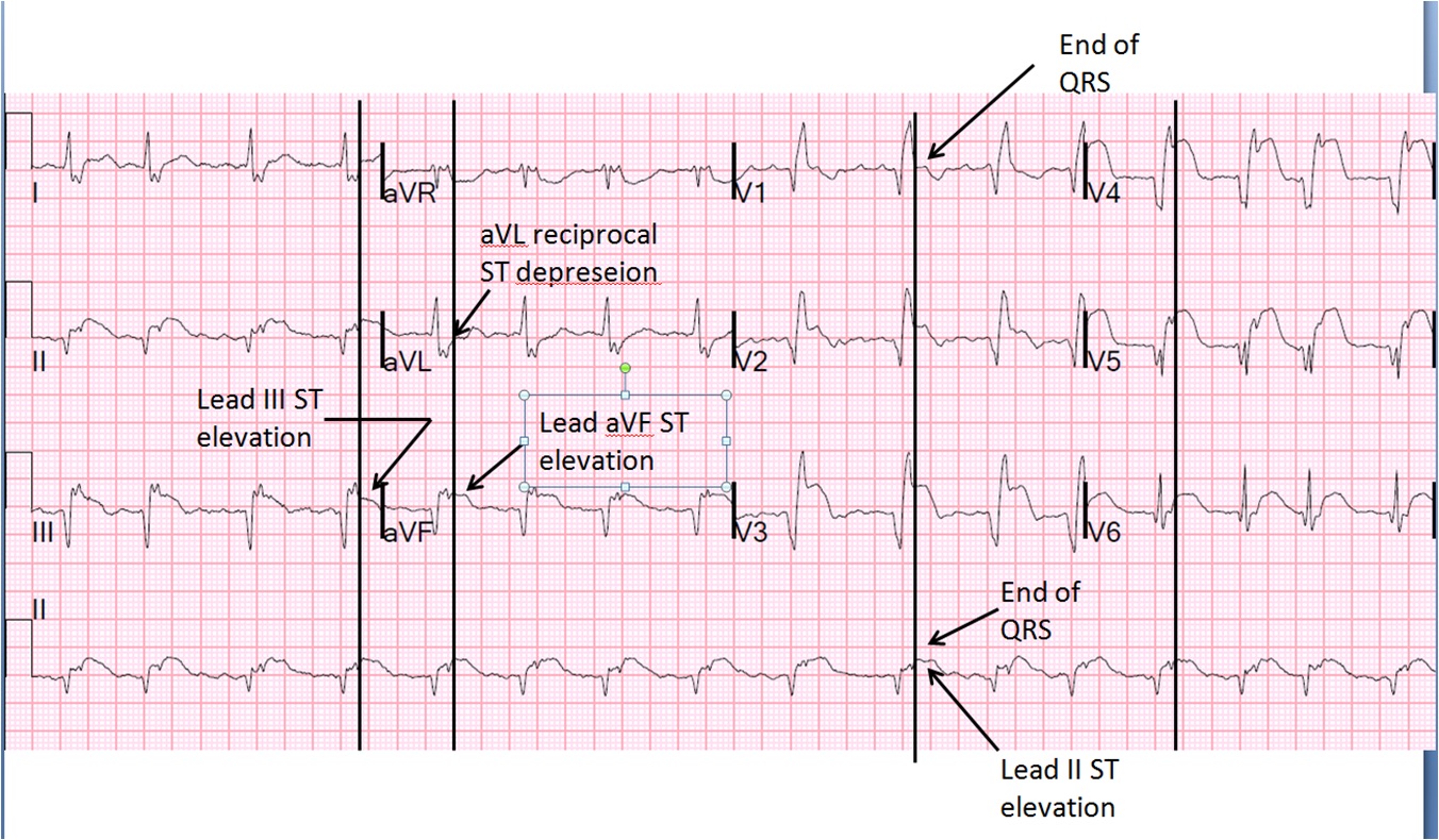 First ECG 4 days after onset of pain-arrows