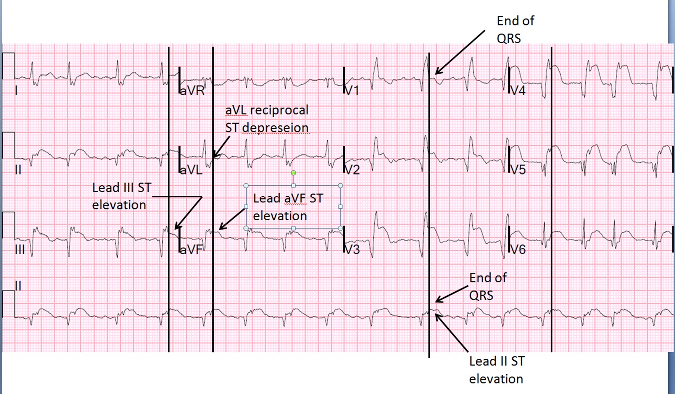 what-are-the-symptoms-of-an-anterior-infarction-quora