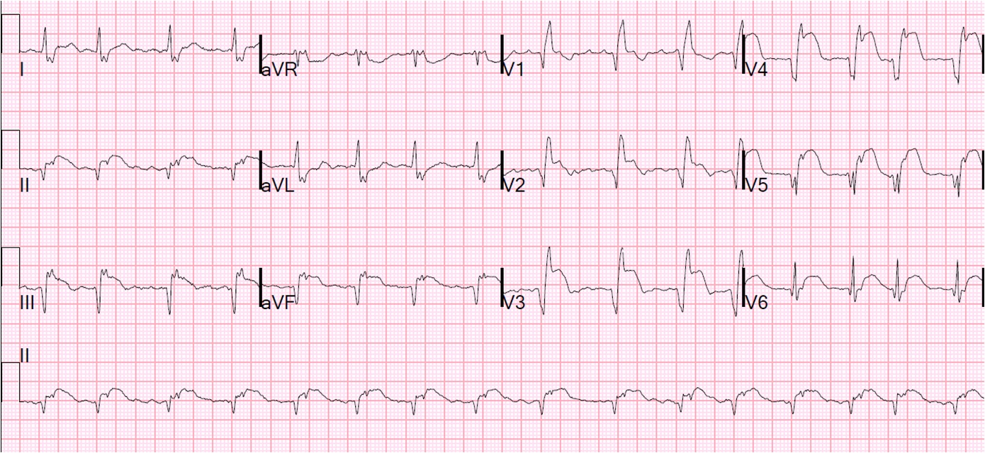 First ECG 4 days after onset of pain